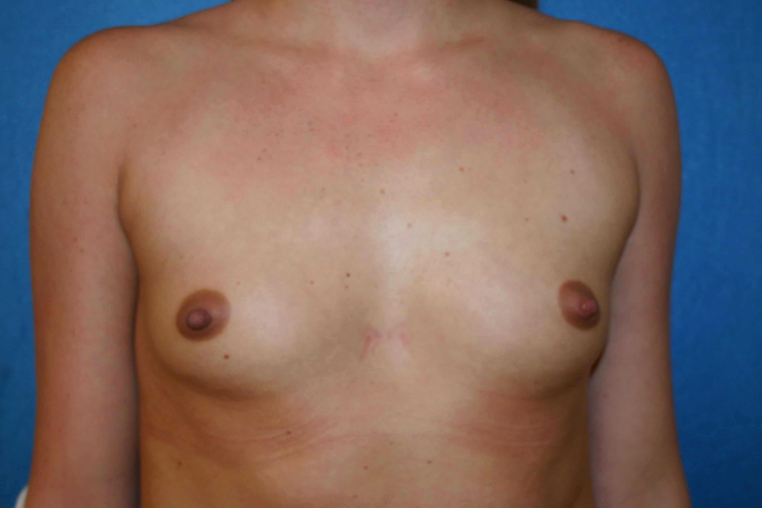 Breast Before